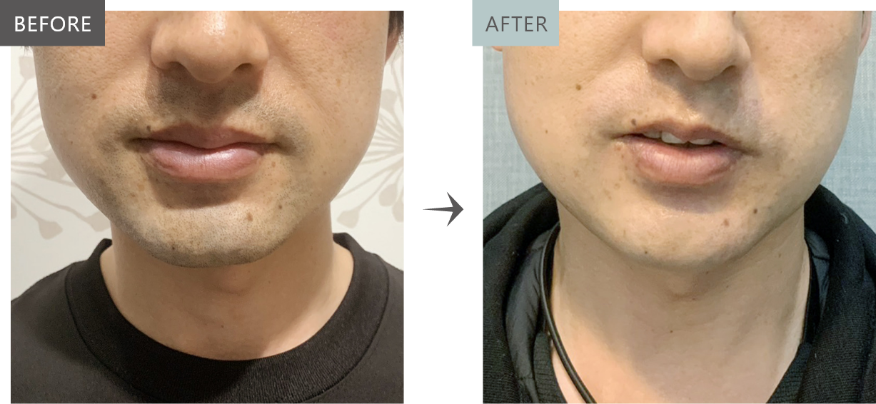 BEFORE AFTER